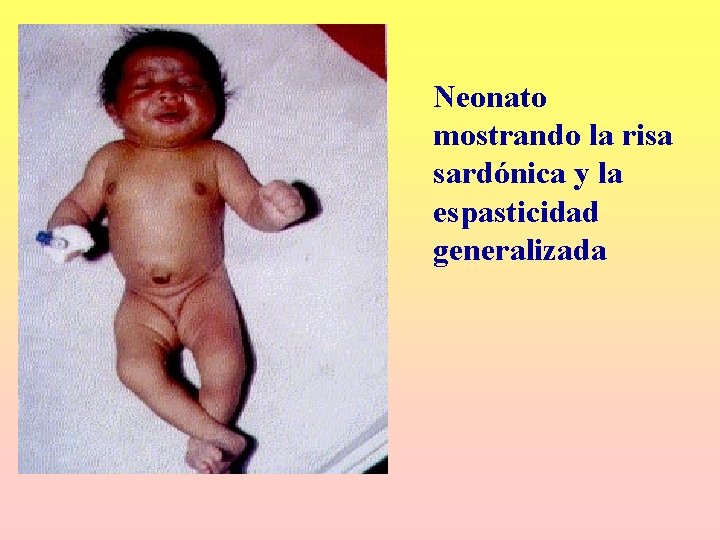 Neonato mostrando la risa sardónica y la espasticidad generalizada Neonato mostrando la risa sardónica y la espasticidad generalizada