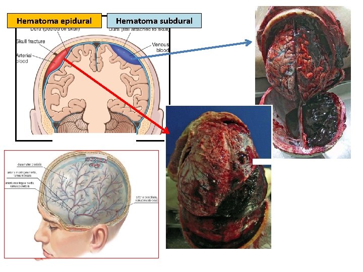 Hematoma epidural Hematoma subdural 