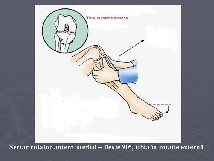 Sertar rotator antero-medial – flexie 90°, tibia în rotaţie externă Sertar rotator antero-medial – flexie 90°, tibia în rotaţie externă
