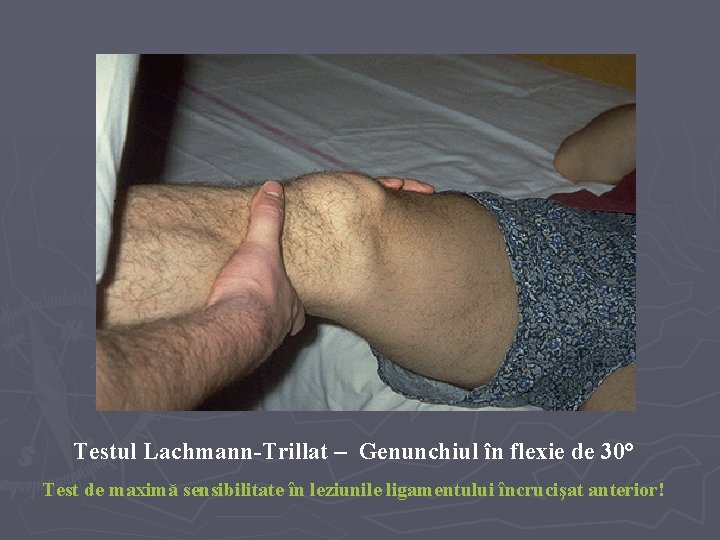 Testul Lachmann-Trillat – Genunchiul în flexie de 30° Test de maximă sensibilitate în leziunile Testul Lachmann-Trillat – Genunchiul în flexie de 30° Test de maximă sensibilitate în leziunile