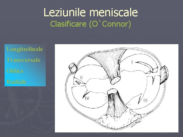 Leziunile meniscale Clasificare (O`Connor) Longitudinale Transversale Oblice Radiale Leziunile meniscale Clasificare (O`Connor) Longitudinale Transversale Oblice Radiale
