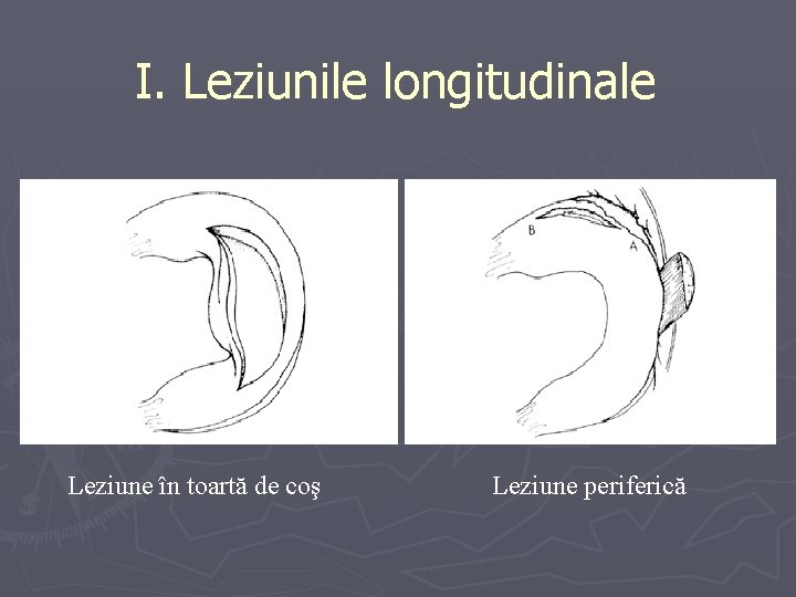 I. Leziunile longitudinale Leziune în toartă de coş Leziune periferică I. Leziunile longitudinale Leziune în toartă de coş Leziune periferică