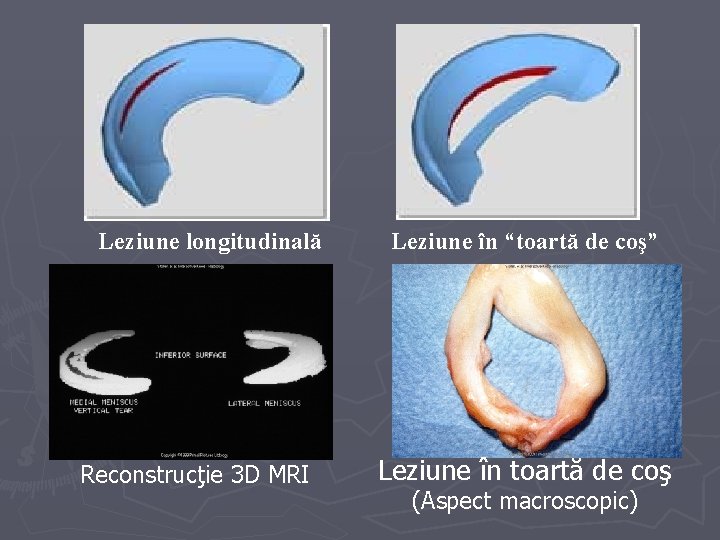 Leziune longitudinală Reconstrucţie 3 D MRI Leziune în “toartă de coş” Leziune în toartă Leziune longitudinală Reconstrucţie 3 D MRI Leziune în “toartă de coş” Leziune în toartă