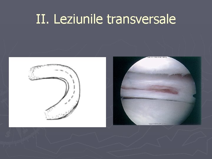 II. Leziunile transversale II. Leziunile transversale