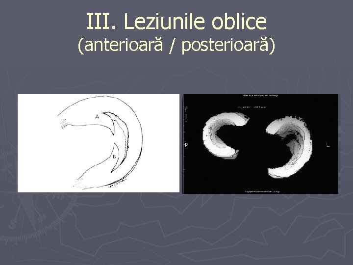 III. Leziunile oblice (anterioară / posterioară) III. Leziunile oblice (anterioară / posterioară)