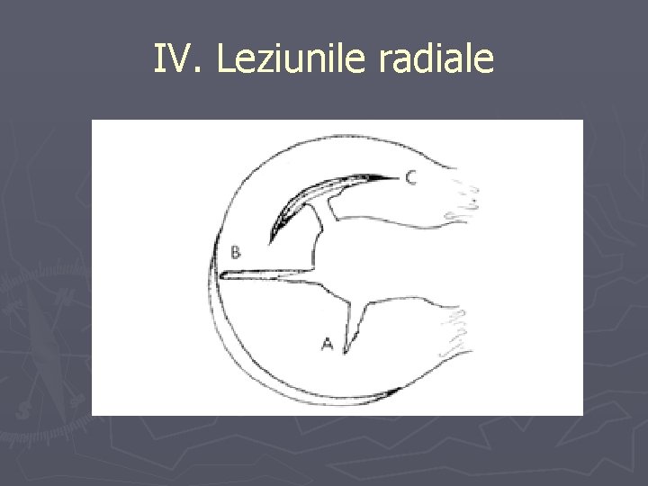 IV. Leziunile radiale IV. Leziunile radiale