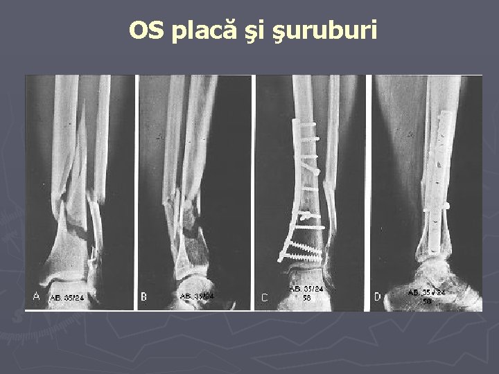 OS placă şi şuruburi OS placă şi şuruburi