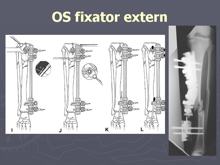 OS fixator extern OS fixator extern