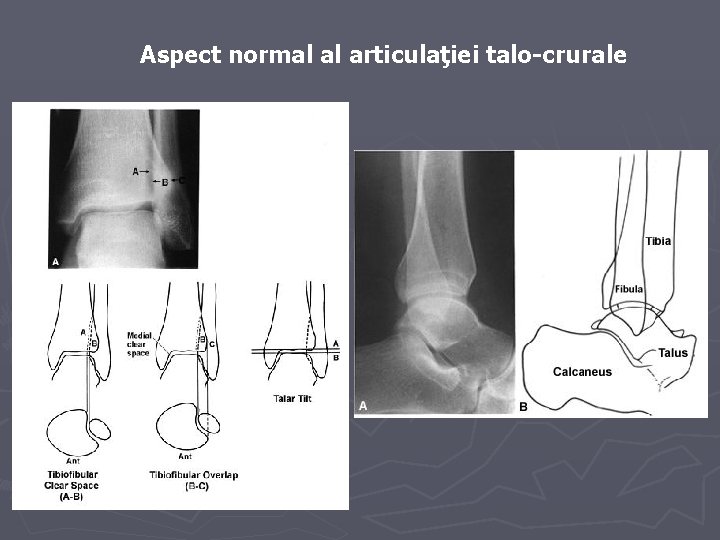 Aspect normal al articulaţiei talo-crurale Aspect normal al articulaţiei talo-crurale