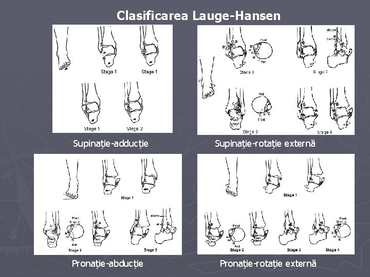 Clasificarea Lauge-Hansen Supinaţie-adducţie Pronaţie-abducţie Supinaţie-rotaţie externă Pronaţie-rotaţie externă Clasificarea Lauge-Hansen Supinaţie-adducţie Pronaţie-abducţie Supinaţie-rotaţie externă Pronaţie-rotaţie externă