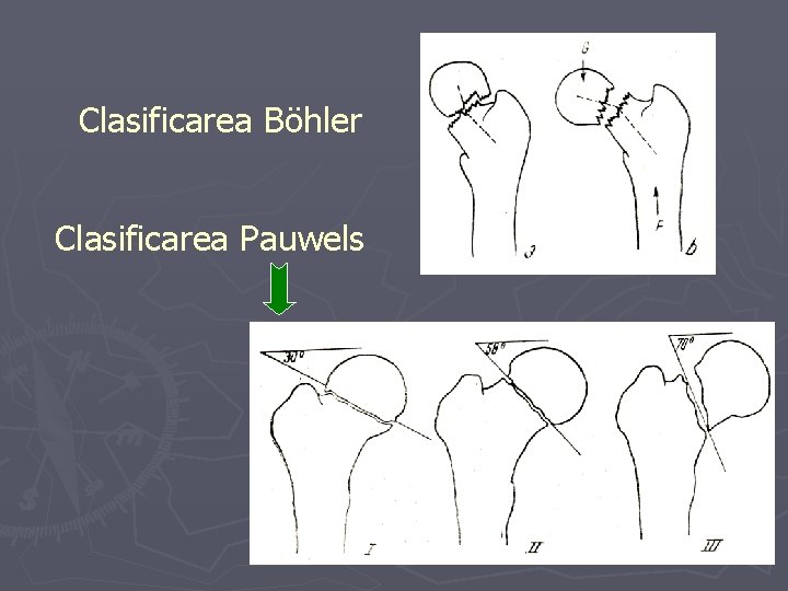 Clasificarea Böhler Clasificarea Pauwels Clasificarea Böhler Clasificarea Pauwels