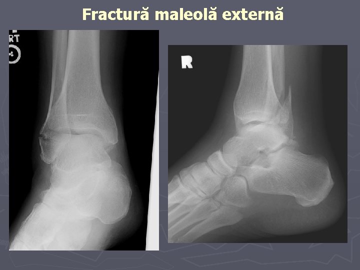 Fractură maleolă externă Fractură maleolă externă