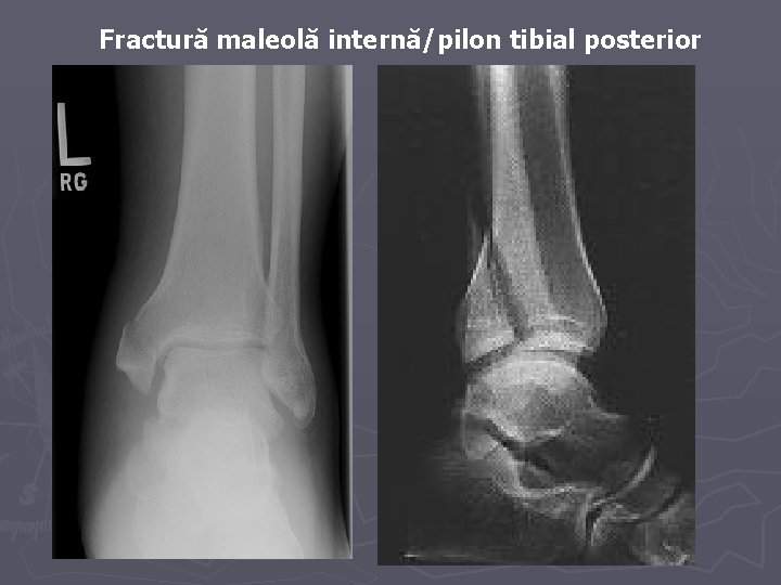 Fractură maleolă internă/pilon tibial posterior Fractură maleolă internă/pilon tibial posterior