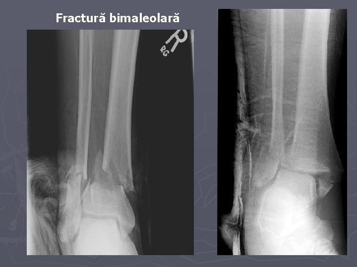 Fractură bimaleolară Fractură bimaleolară