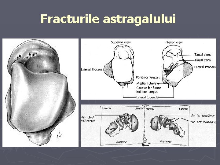 Fracturile astragalului Fracturile astragalului