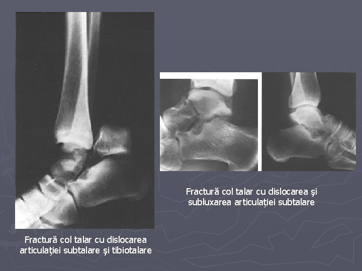 Fractură col talar cu dislocarea şi subluxarea articulaţiei subtalare Fractură col talar cu dislocarea Fractură col talar cu dislocarea şi subluxarea articulaţiei subtalare Fractură col talar cu dislocarea