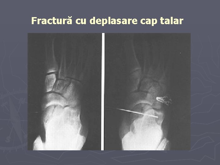 Fractură cu deplasare cap talar Fractură cu deplasare cap talar