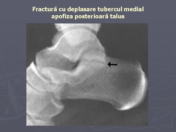 Fractură cu deplasare tubercul medial apofiza posterioară talus Fractură cu deplasare tubercul medial apofiza posterioară talus
