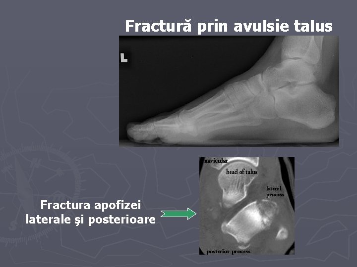 Fractură prin avulsie talus Fractura apofizei laterale şi posterioare Fractură prin avulsie talus Fractura apofizei laterale şi posterioare