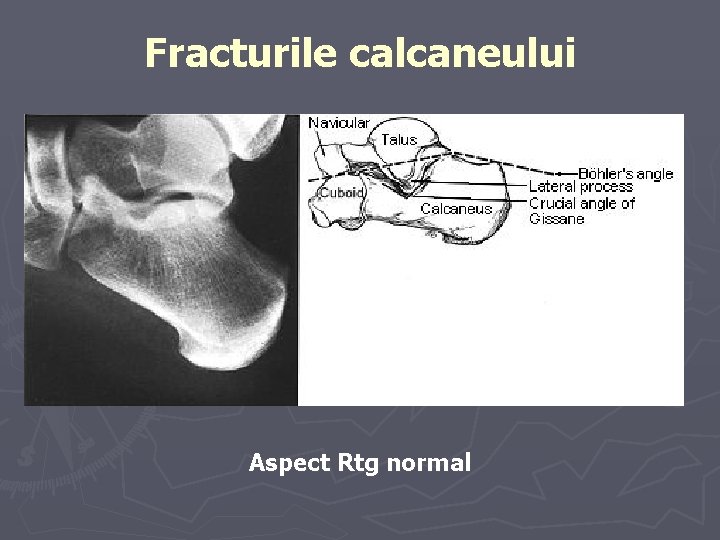 Fracturile calcaneului Aspect Rtg normal Fracturile calcaneului Aspect Rtg normal