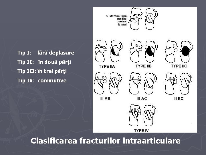 Tip I: fără deplasare Tip II: în două părţi Tip III: în trei părţi Tip I: fără deplasare Tip II: în două părţi Tip III: în trei părţi