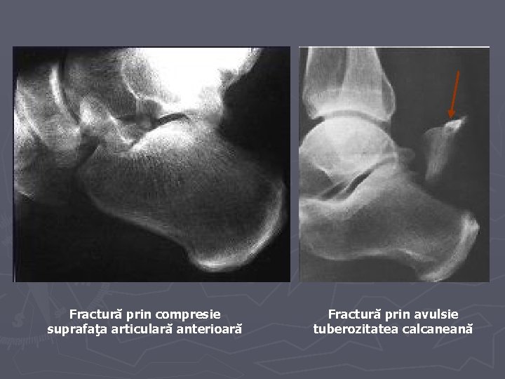 Fractură prin compresie suprafaţa articulară anterioară Fractură prin avulsie tuberozitatea calcaneană Fractură prin compresie suprafaţa articulară anterioară Fractură prin avulsie tuberozitatea calcaneană