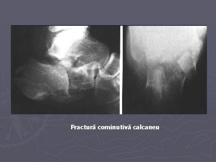Fractură cominutivă calcaneu Fractură cominutivă calcaneu