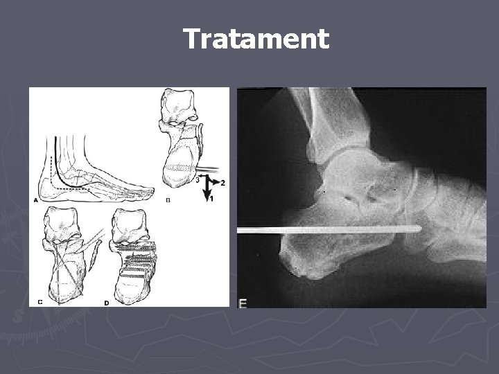 Tratament Tratament