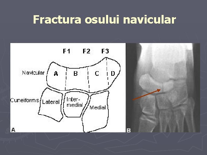 Fractura osului navicular Fractura osului navicular