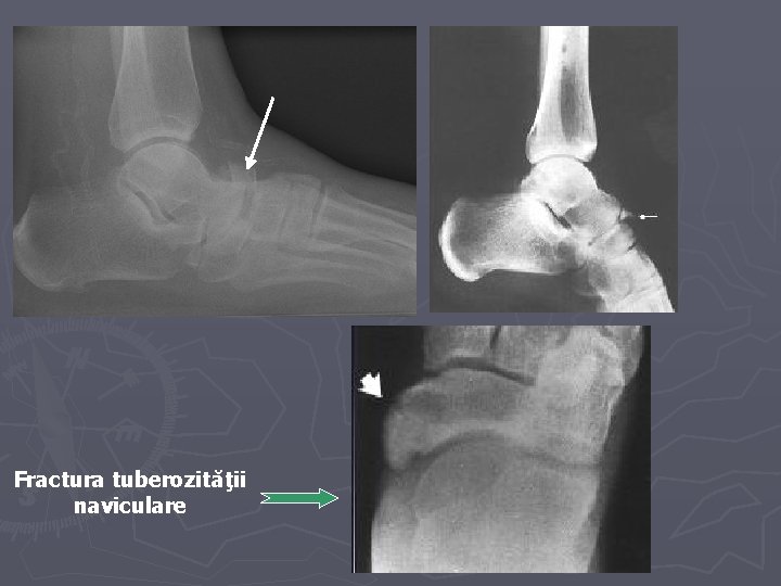 Fractura tuberozităţii naviculare Fractura tuberozităţii naviculare