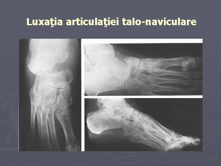 Luxaţia articulaţiei talo-naviculare Luxaţia articulaţiei talo-naviculare