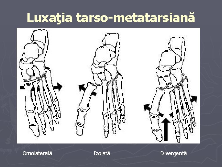 Luxaţia tarso-metatarsiană Omolaterală Izolată Divergentă Luxaţia tarso-metatarsiană Omolaterală Izolată Divergentă