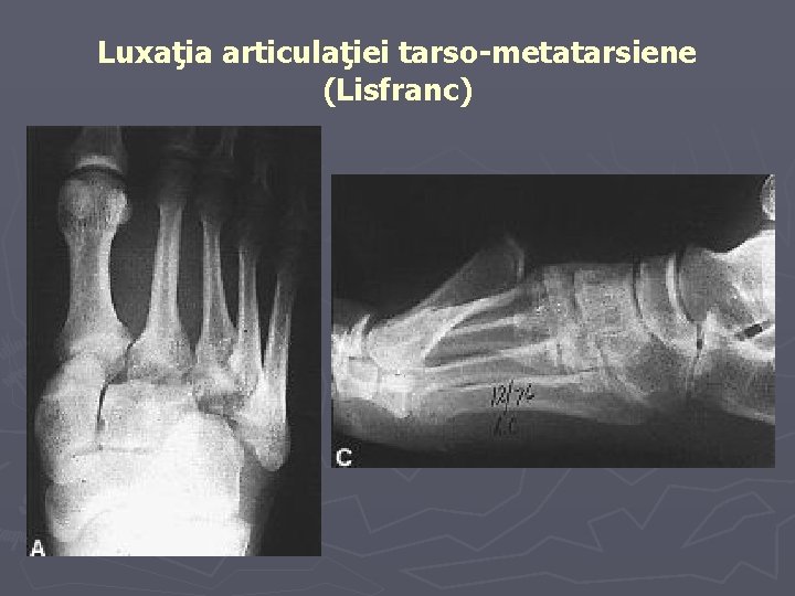 Luxaţia articulaţiei tarso-metatarsiene (Lisfranc) Luxaţia articulaţiei tarso-metatarsiene (Lisfranc)
