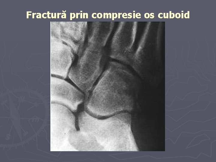 Fractură prin compresie os cuboid Fractură prin compresie os cuboid