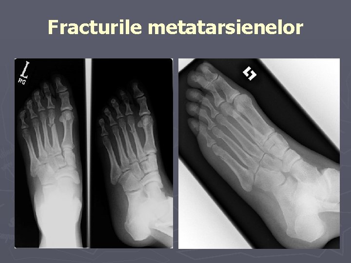 Fracturile metatarsienelor Fracturile metatarsienelor