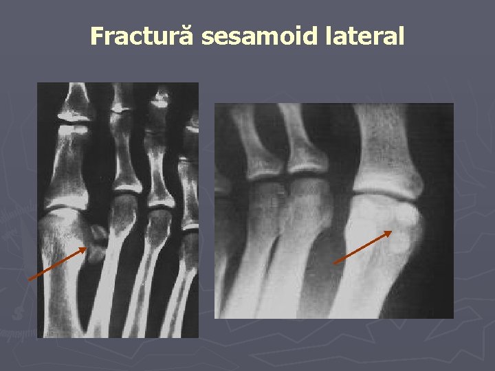Fractură sesamoid lateral Fractură sesamoid lateral