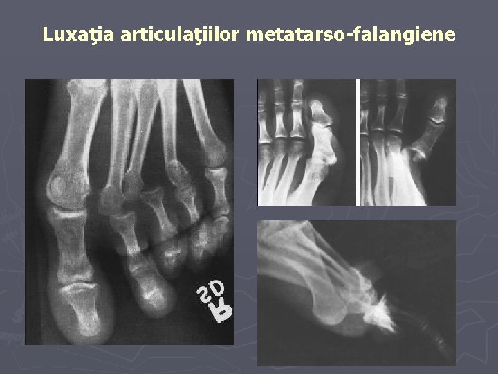 Luxaţia articulaţiilor metatarso-falangiene Luxaţia articulaţiilor metatarso-falangiene