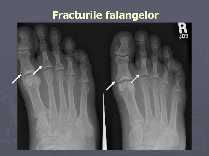 Fracturile falangelor Fracturile falangelor
