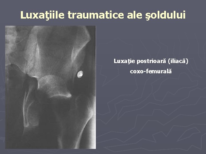 Luxaţiile traumatice ale şoldului Luxaţie postrioară (iliacă) coxo-femurală Luxaţiile traumatice ale şoldului Luxaţie postrioară (iliacă) coxo-femurală
