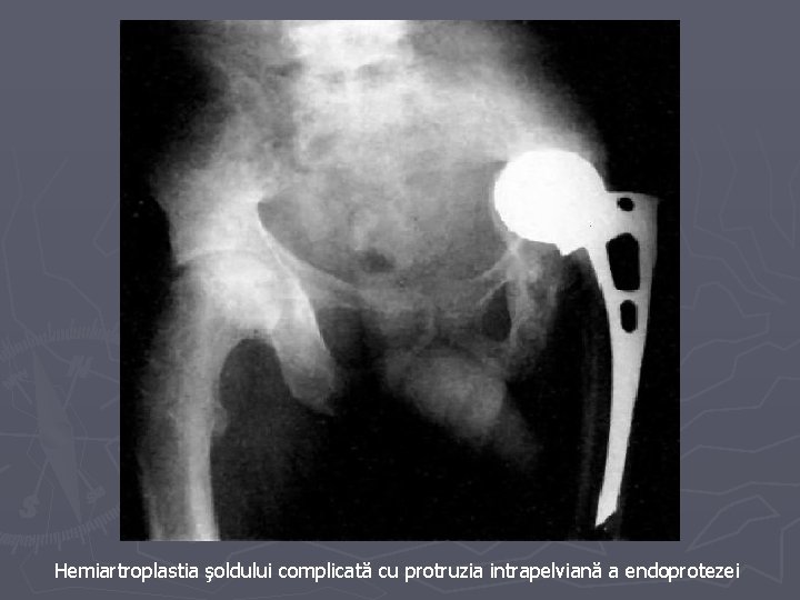 Hemiartroplastia şoldului complicată cu protruzia intrapelviană a endoprotezei Hemiartroplastia şoldului complicată cu protruzia intrapelviană a endoprotezei