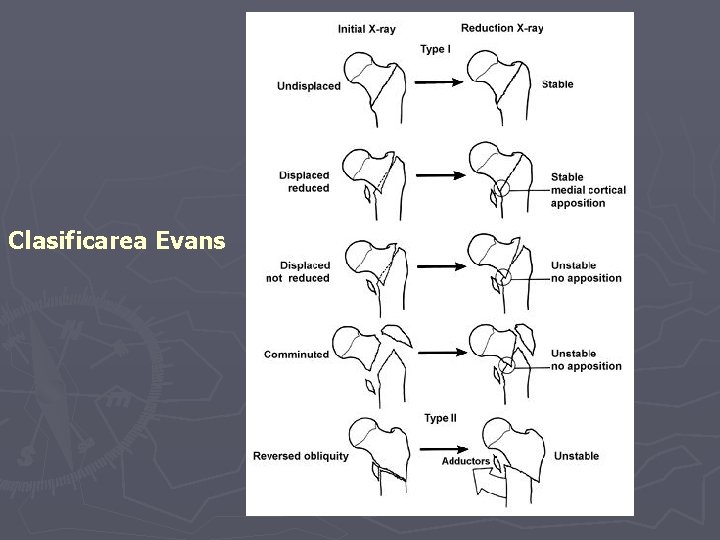 Clasificarea Evans Clasificarea Evans