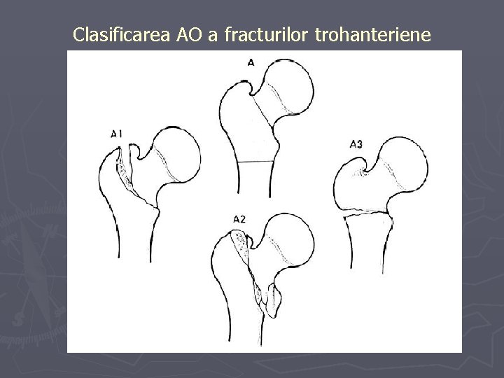 Clasificarea AO a fracturilor trohanteriene Clasificarea AO a fracturilor trohanteriene