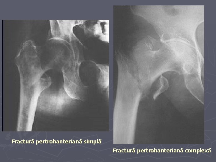 Fractură pertrohanteriană simplă Fractură pertrohanteriană complexă Fractură pertrohanteriană simplă Fractură pertrohanteriană complexă