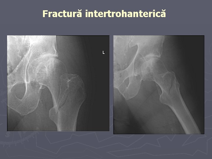 Fractură intertrohanterică Fractură intertrohanterică
