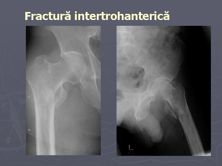 Fractură intertrohanterică Fractură intertrohanterică