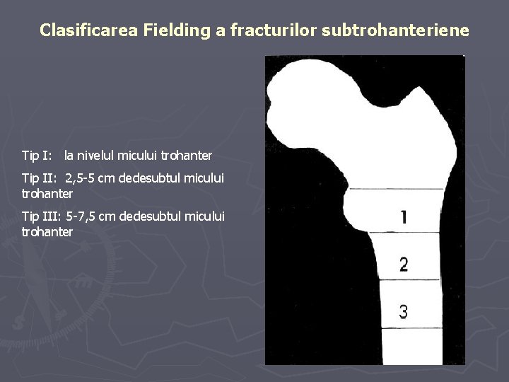 Clasificarea Fielding a fracturilor subtrohanteriene Tip I: la nivelul micului trohanter Tip II: 2, Clasificarea Fielding a fracturilor subtrohanteriene Tip I: la nivelul micului trohanter Tip II: 2,