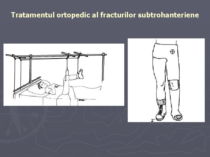 Tratamentul ortopedic al fracturilor subtrohanteriene Tratamentul ortopedic al fracturilor subtrohanteriene