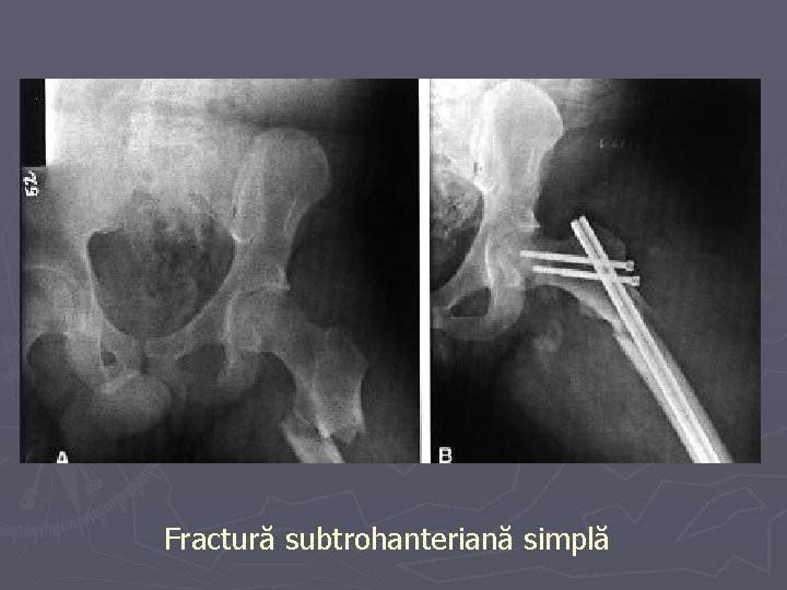 Fractură subtrohanteriană simplă Fractură subtrohanteriană simplă