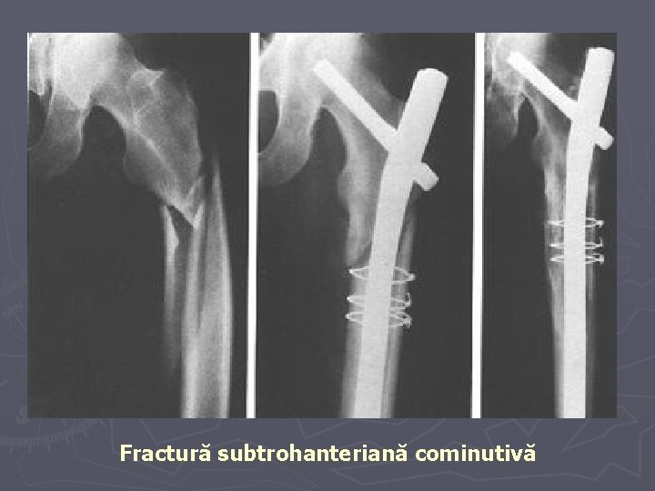 Fractură subtrohanteriană cominutivă Fractură subtrohanteriană cominutivă