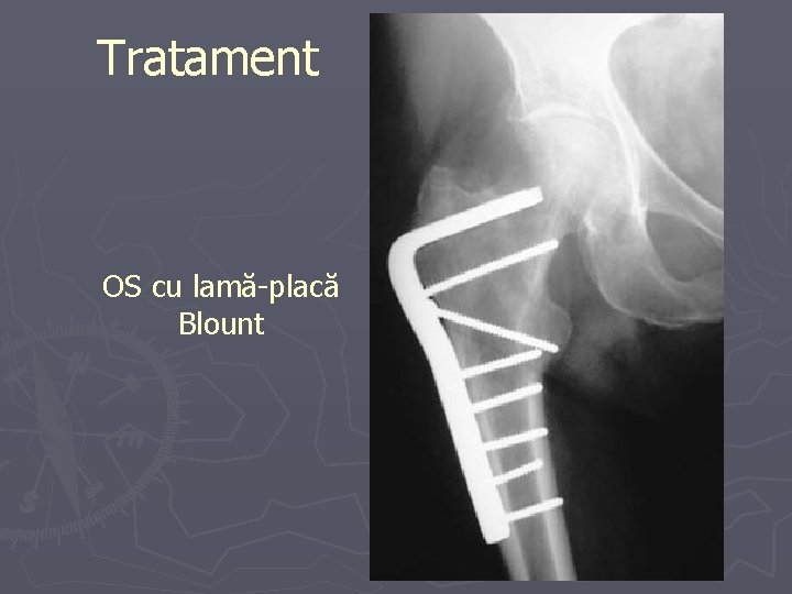 Tratament OS cu lamă-placă Blount Tratament OS cu lamă-placă Blount